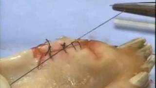 Introduction to Periodontal Surgery Techniques Initial Incisions and Suturing [upl. by Ladd559]