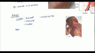 Staphylococcal Scalded Skin Syndrome SSSS and Bullous Impetigo [upl. by Milson]