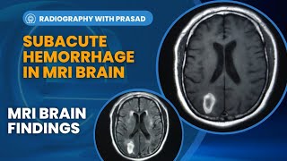 Late Subacute Hemorrhage in MRI Brain  How can you find the Stages of Hemorrhage in MRI [upl. by Currie]