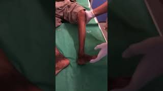 Demonstration of Sustained Ankle Clonus Dept of Medicine JNMC [upl. by Gwenni]