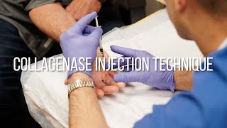 Collagenase Injection Technique for Dupuytrens Contracture [upl. by Ordnasil474]