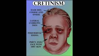 Pathophysiology of Cretinism [upl. by Marge]