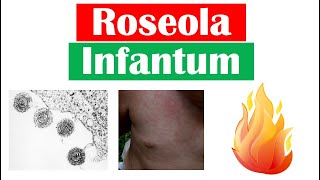 Roseola Infantum Sixth Disease  Symptoms Fever amp Rash in Infants Diagnosis Treatment [upl. by Barbey90]