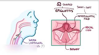 laryngomalacia [upl. by Enad748]