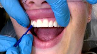 Tips For Applying Fluoride Varnish [upl. by Hube]