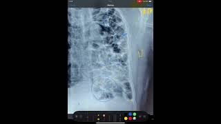 BRONCHIECTASIS FIBROSIS OF LUNGS MEDIASTINAL SHIFT X RAY CHEST [upl. by Eelrihs]