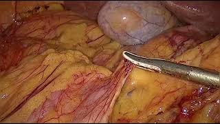 Laparoscopic assisted right hemicolectomy [upl. by Hallam]