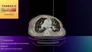 CT assessment  evaluating pulmonary lymphangitis carcinomatosis [upl. by Arimas]