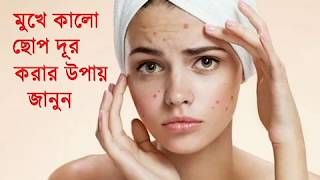 চিকেন পক্স বা বসন্ত হলে যা করবেন  Get Rid of Chicken Pox FAST  Heres the Secret [upl. by Eidod]