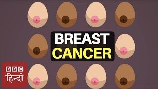 How To Recognise 12 Symptoms of Breast Cancer  BBC Duniya [upl. by Akkim657]