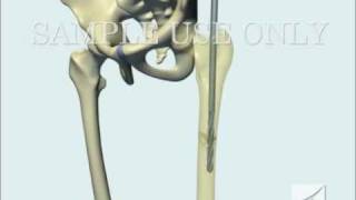 Femoral Fracture Fixation Surgery Intramedullary Nail [upl. by Yerak]