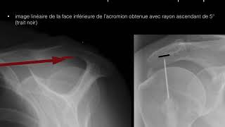 bursographie infiltration BSAD sous guidage radiographique [upl. by Heiney463]