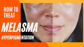 Melasma Removal at Home I Melasma Remove cream I Melasma Skin Care Regimen Routine [upl. by Gwendolen]