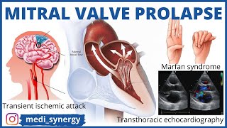 Mitral Valve Prolapse  Basics  Clinical Features  Investigation Complications Treatment HINDI [upl. by Weed]