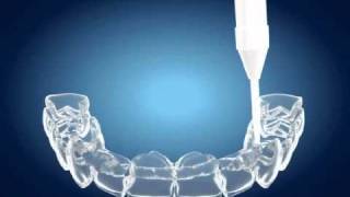 Tooth Whitening  Home Bleaching [upl. by Oramug620]