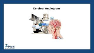 Cerebral Angiogram [upl. by Dewain]