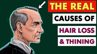 The REAL Causes of HAIR LOSS [upl. by Theodor481]