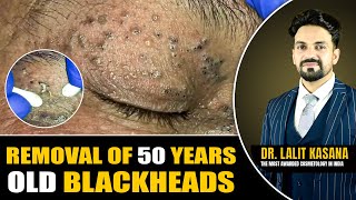 REMOVAL OF 50 YEARS OLD BLACKHEADS II Dr Lalit Kasanas [upl. by Aranat]