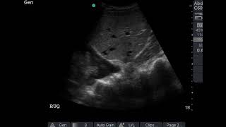 Pleural effusion with lung collapse amp spine sign in right hemithorax [upl. by Korb]