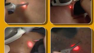 Laser Hair Removal video by Cynosure [upl. by Oly]