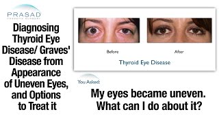 Thyroid Problems can Cause Uneven Eyes  Diagnosis and Eye Surgery Important Before Cosmetic Surgery [upl. by Ahsirk]