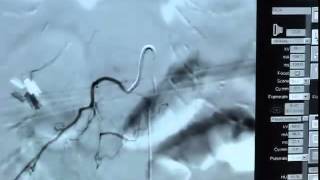 Spinal ArterAngio 033012mp4 [upl. by Norvin]