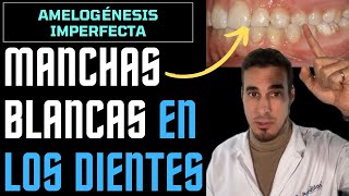 MANCHAS BLANCAS en los DIENTES  Amelogénesis imperfecta o hipoplasia de esmalte [upl. by Toni]