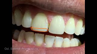 Restaurar correctamente un borde incisal [upl. by Beedon]