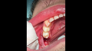 How to pull a broken tooth  First Molar extraction  قلع جراحي [upl. by Kiona]