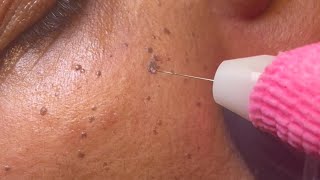 DPN Dermatosis Papulosa Nigra Removal [upl. by Falcone580]