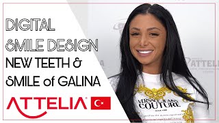 DIGITAL SMILE MAKEOVER for GALINA from BULGARIA [upl. by Holmun370]