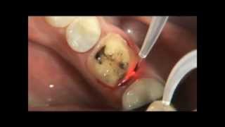 PHILIPS LASERS Eviction gingivale 3wmv [upl. by Dietz]