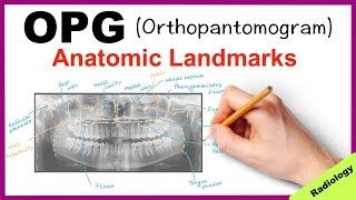 Orthopantomogram OPG Anatomical Landmarks  Radiology [upl. by Longerich]