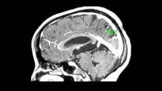 Endoscopic treatment of a third ventricle choroid plexus cyst [upl. by Pier45]