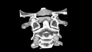 Cervical spine CT scan Atlantoaxial subluxation [upl. by Barram492]