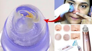 1 min blackheads amp whiteheads remove method OMG IT WORKED suction blackhead remover Review amp Demo [upl. by Tallulah]