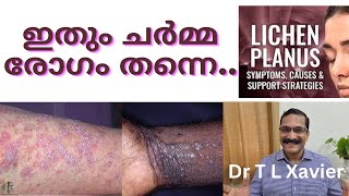 Lichen Planus Ayurvedic Solutions  Dr T L Xavier [upl. by Sievert]