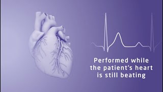 Treatment for tricuspid regurgitation at Northwestern Medicine [upl. by Kathye651]