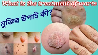 different types of warts and how to treat them warts varuca vulgaris mosaic minoxidil [upl. by Atteras]