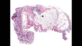 Adenomatous polyp with epithelial displacement forming a mucin pool at the polyp base [upl. by Hpeseoj720]