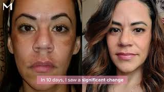 Finally fade melasma amp dark spots The results are REAL  Musely Reviews [upl. by Alexandre]