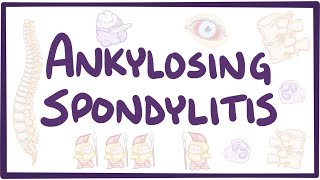 Ankylosing spondylitis  causes symptoms diagnosis treatment pathology [upl. by Michey]