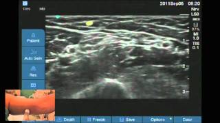 Ultrasound location of Intercostobrachial nerve [upl. by Pasadis]