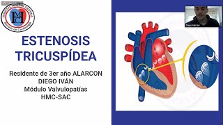 Clase Estenosis Tricuspidea  Cardio HMC [upl. by Aital]