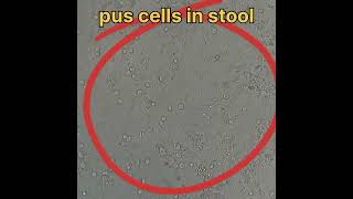 pus cells in stool under microscope [upl. by Ostap]