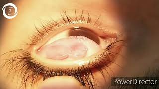 Giant papillary conjunctivitis [upl. by Ahsenom]