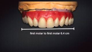 How to obtain ideal buccal corridors for Allon4 patients [upl. by Trefler]