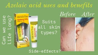 Aziderm azelaic acid cream reviewin tamil Aziderm acne pimple viral yt darkspots [upl. by Eikceb88]