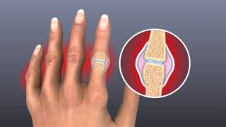 The Pain Swelling And Stiffness of Rheumatoid Arthritis [upl. by Haily]