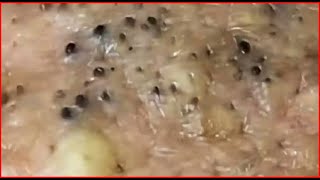 Pimple Popping Blackheads On Skin 😲😲 [upl. by Wrand]